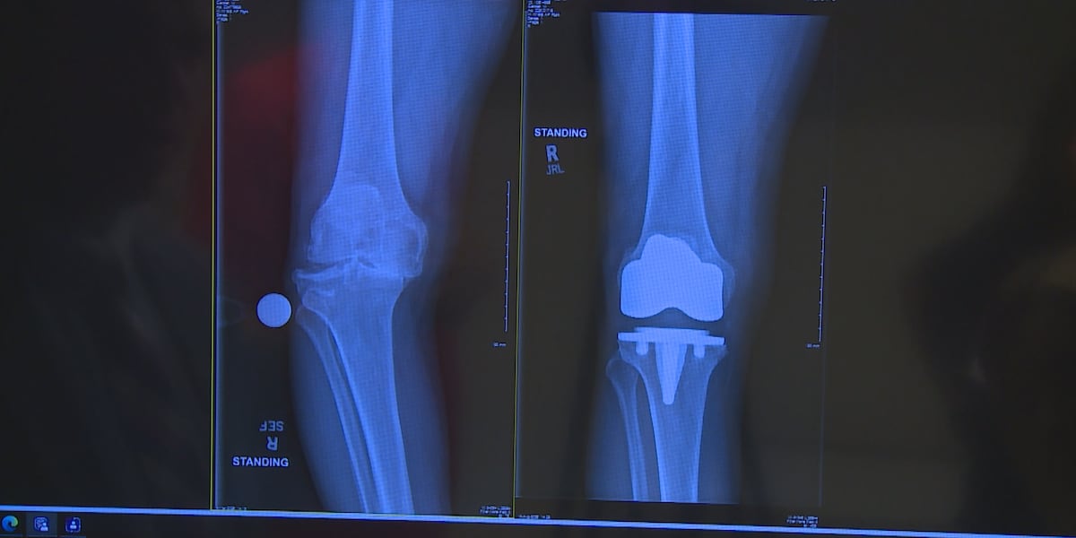 Minimally-invasive knee surgery technique bends recovery time for the better