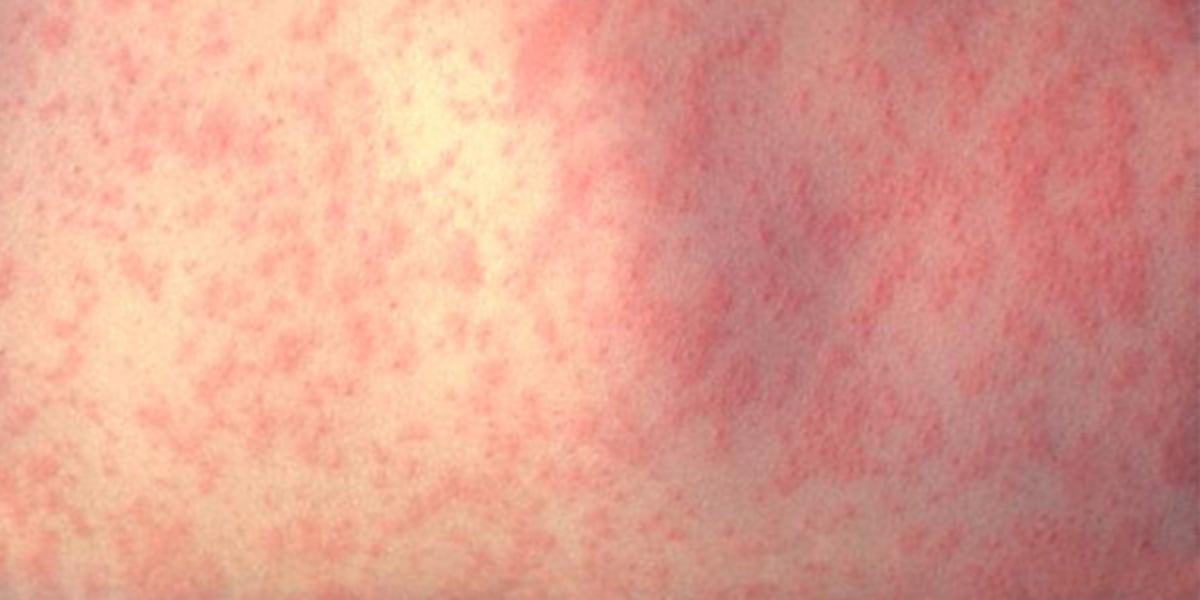 Measles exposure reported at Topeka hospital - WIBW