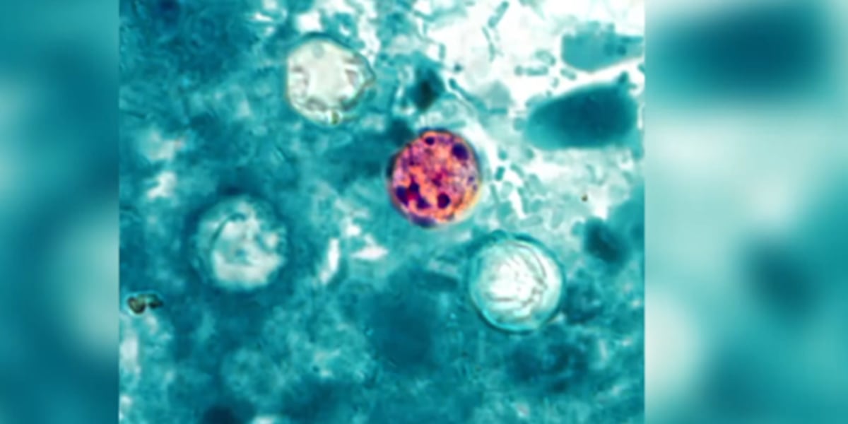 Cyclosporiasis data shows increase by 22 cases, totaling 829 cases in Kansas